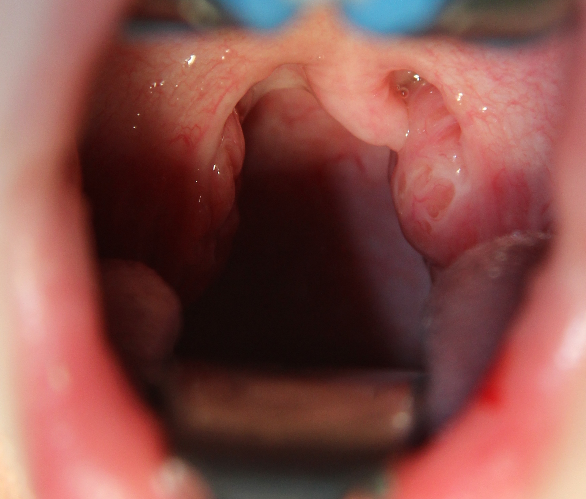 Tonsils and tonsillectomy — Mr Daniel Tweedie - Consultant Paediatric ENT  Surgeon, London
