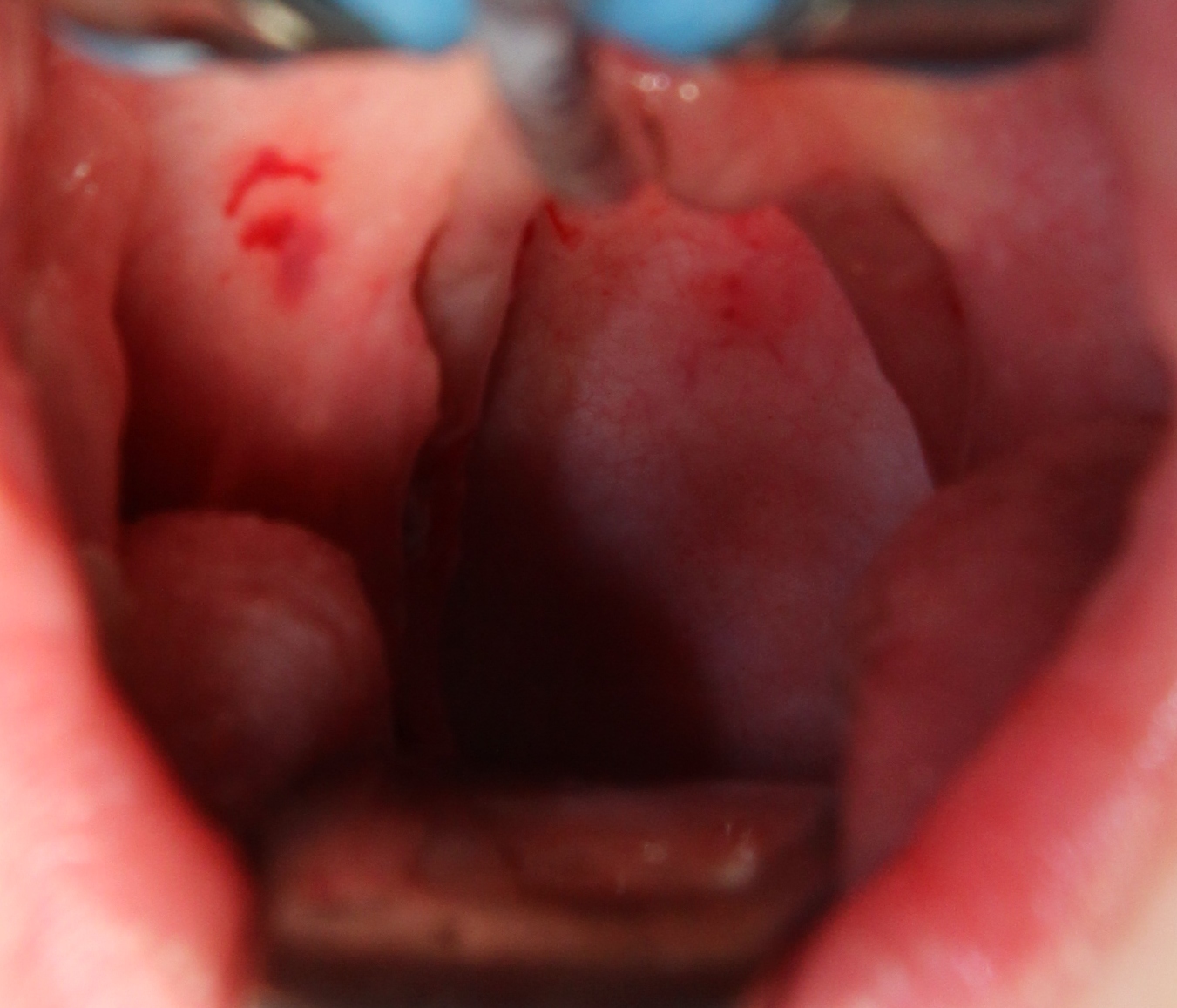 The appearance immediately after Coblation intracapsular tonsillectomy. The muscles of the throat are intact, and there is no obvious tonsil tissue to see (Daniel Tweedie).