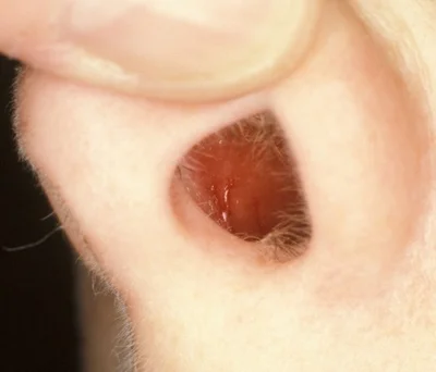 The Little's Area at the front of the nasal septum (Michael Hawke MD)