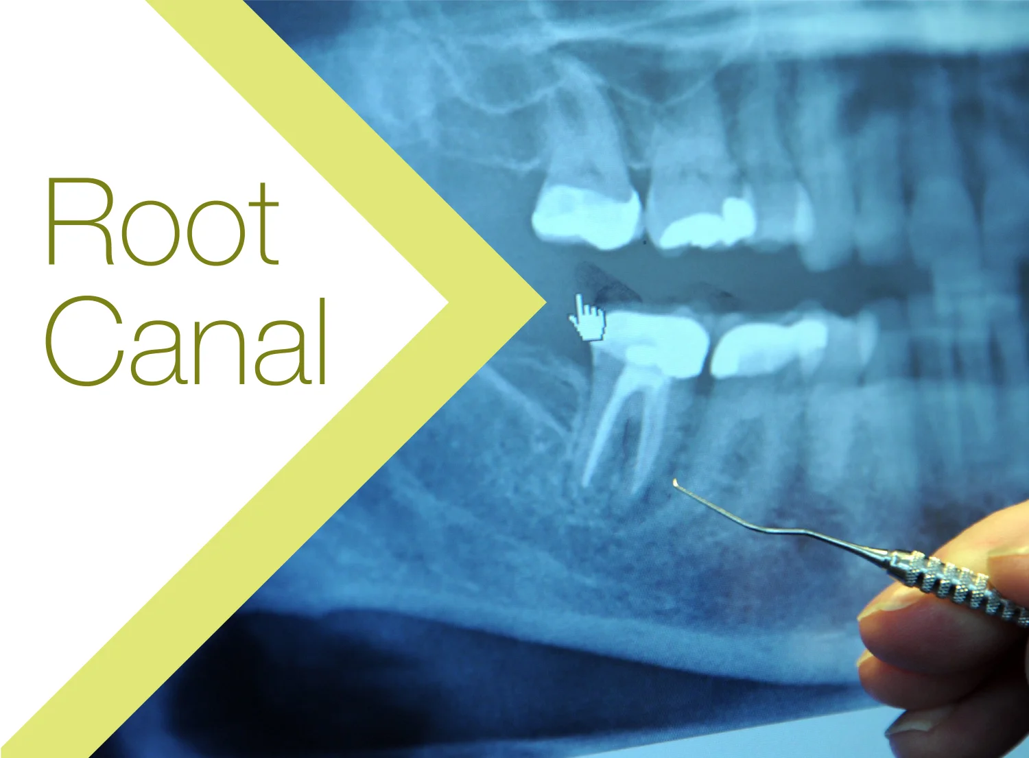 Glendowie Dental_Services_Root Canal.jpg