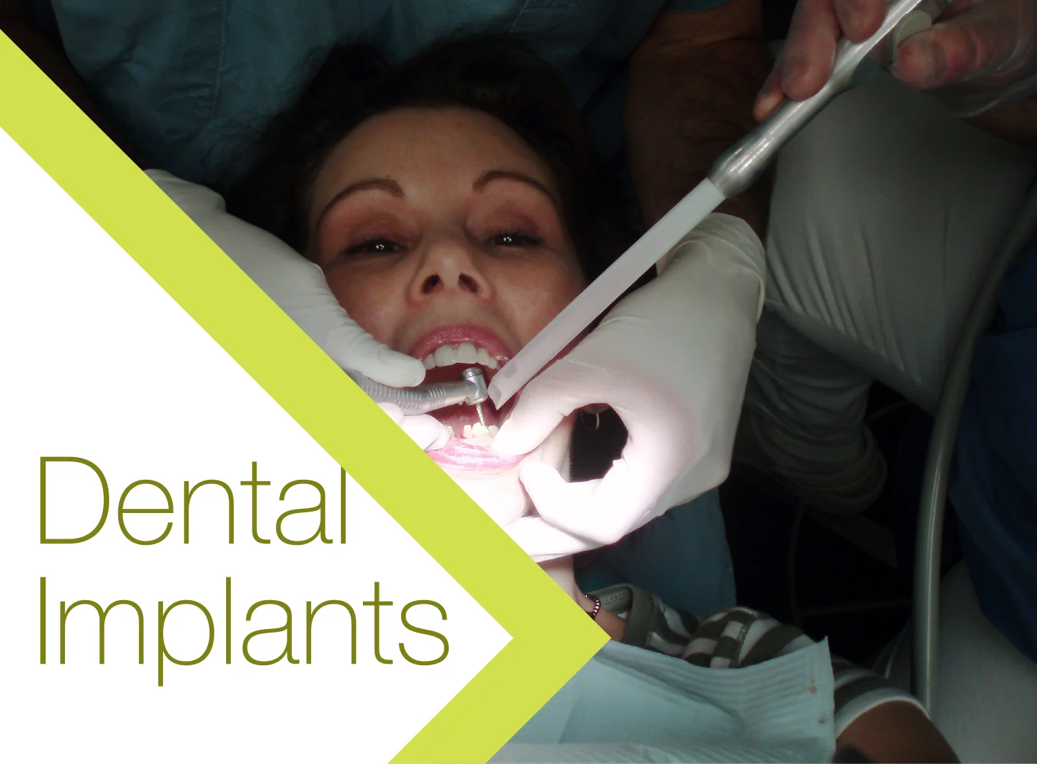 Glendowie Dental_Services_Dental Implant.jpg