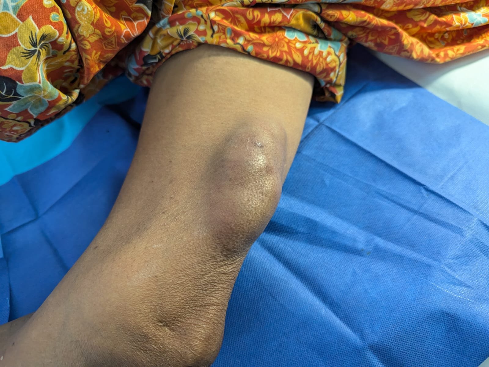 large cyst1.jpg