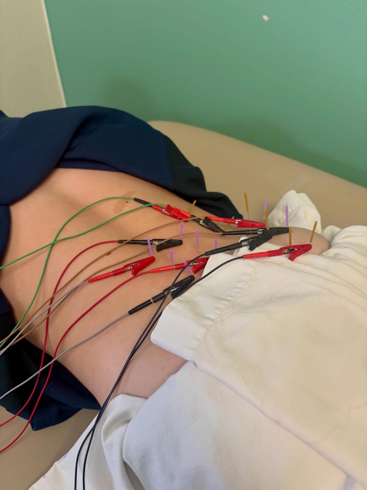 Dry Needling