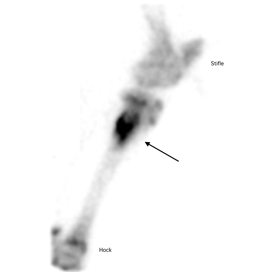  Arrow indicates a marked focus of increased radionucleotide uptake in the upper tibia, associated with a tibial stress fracture. 