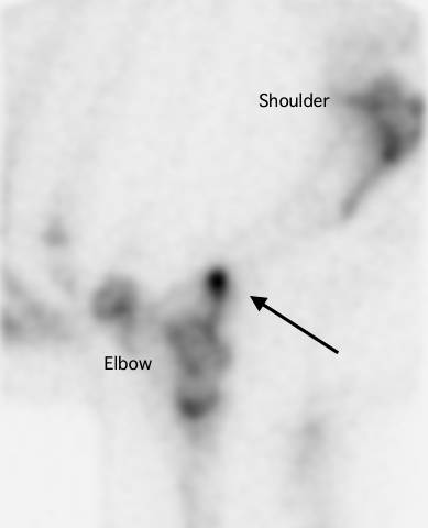  The arrow in this bone scan identifies a 'hot spot' indicating a humeral fracture towards the lower end of the bone, just above the elbow. 