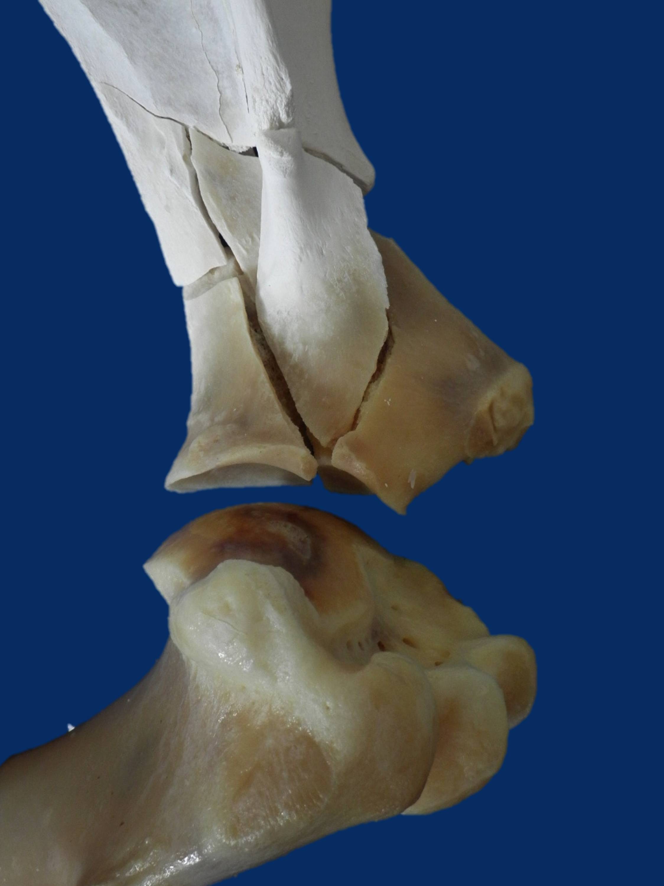  A close up shows how the scapular fracture extends into the shoulder joint. 