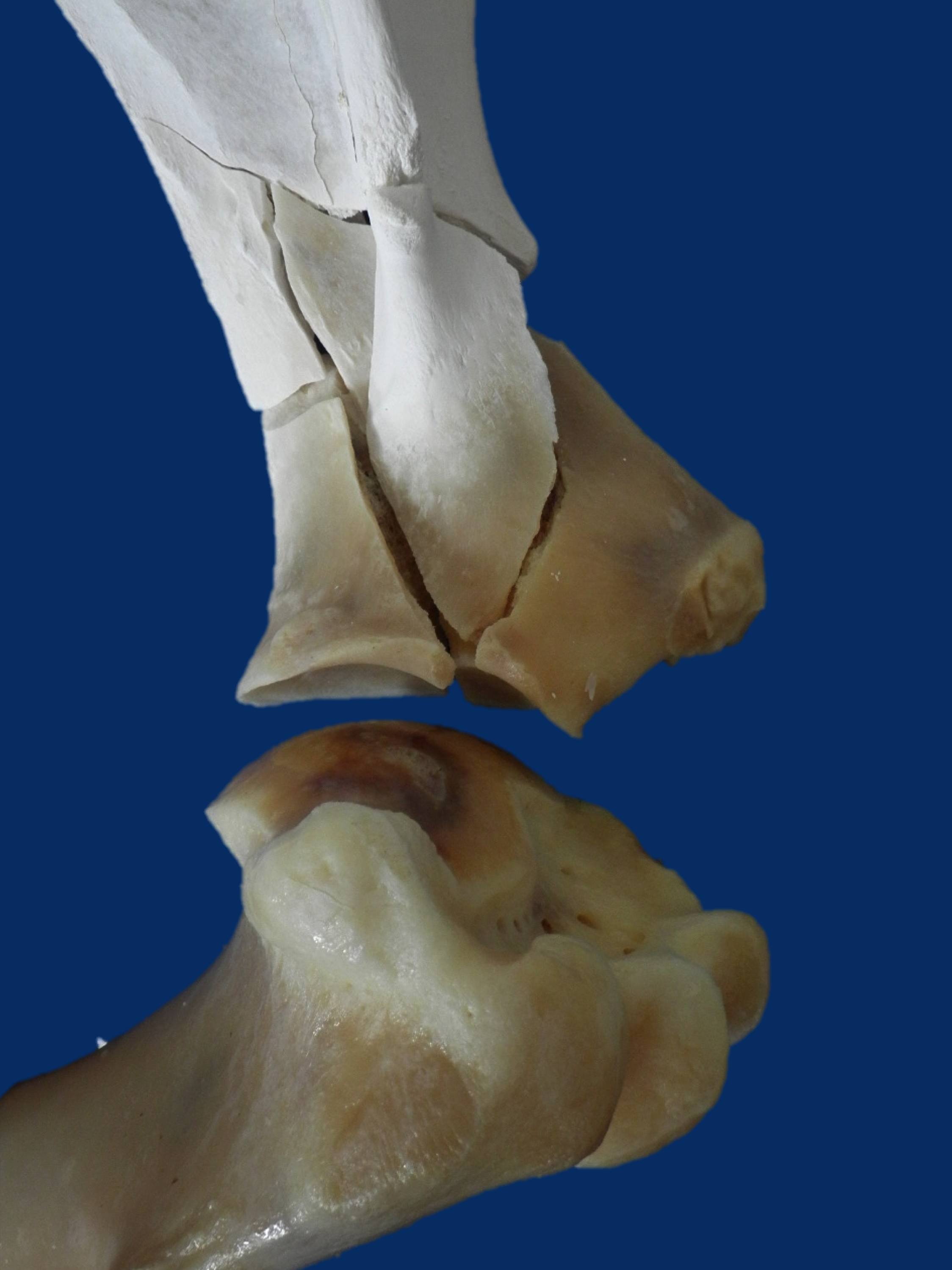 A close up shows how the scapular fracture extends into the shoulder joint.