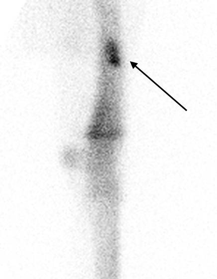  The arrow in this bone identifies increased radionucleotide uptake indicating a radial stress fracture. 
