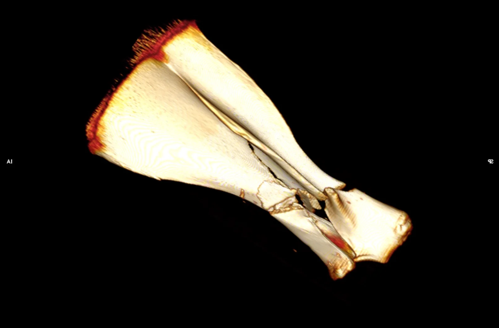 This CT image taken during an autopsy, shows a comminuted fracture with multiple bone fragments.