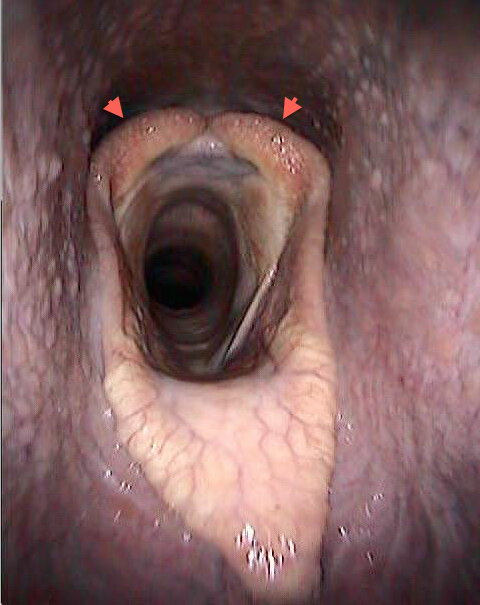 Left: A normal larynx from a Thoroughbred colt with no abnormal respiratory noises. Right: This dynamic endoscopy shows marked left arytenoid and vocal cord collapse.