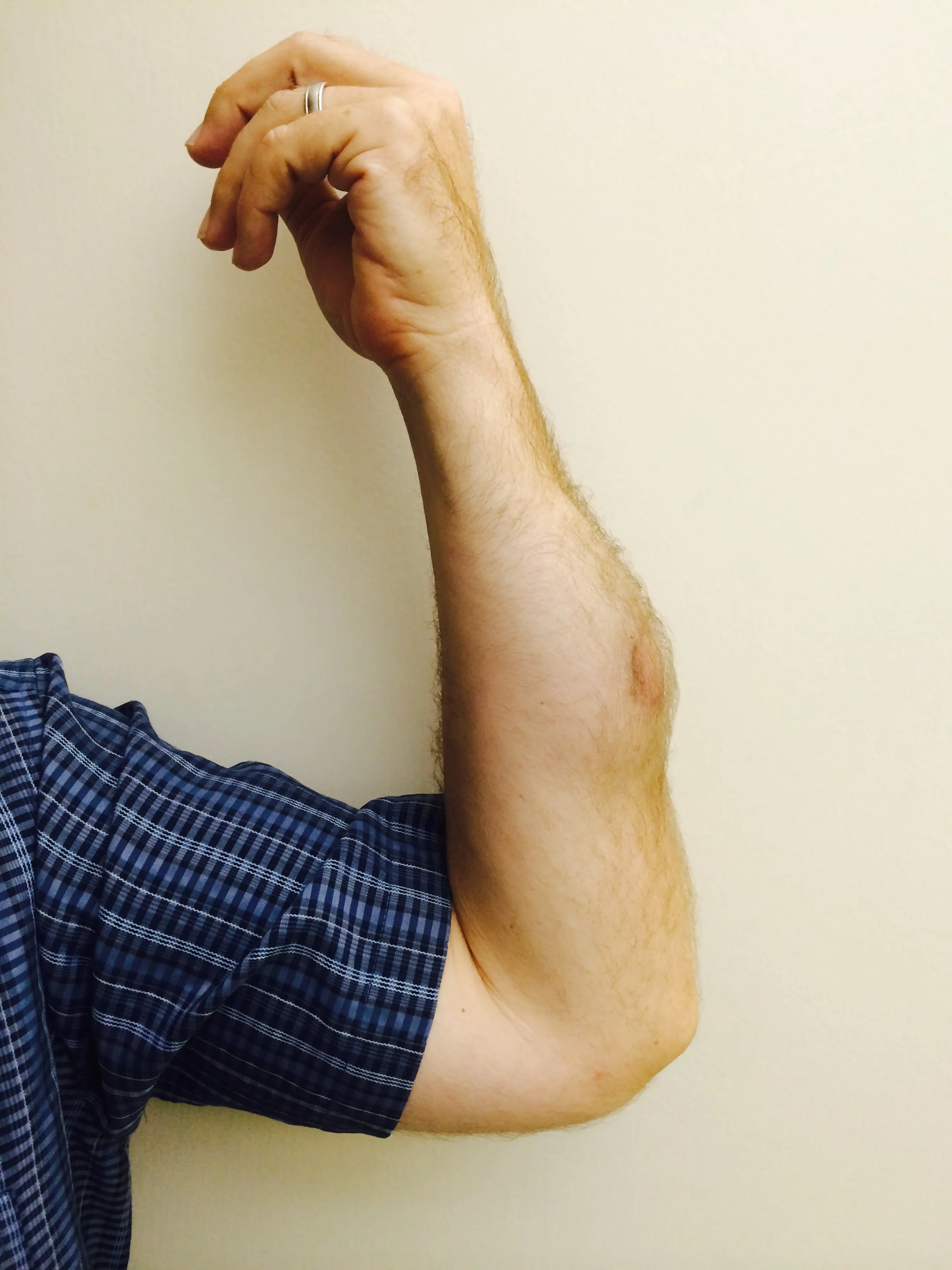 The aftermath of my left forearm after being struck with a rubber bullet
