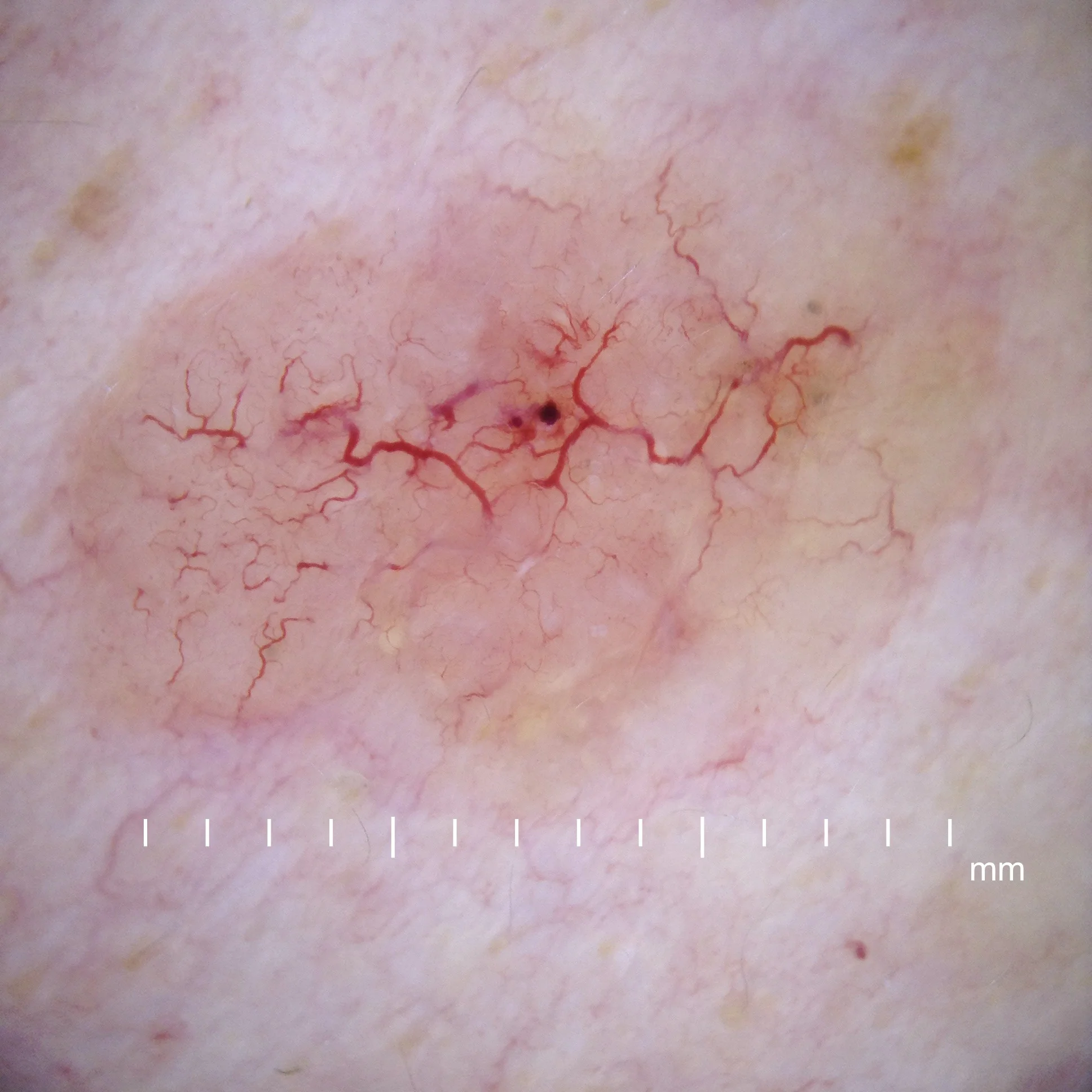 Dermoscopy_nodular_basal_cell_carcinoma-useable.jpg