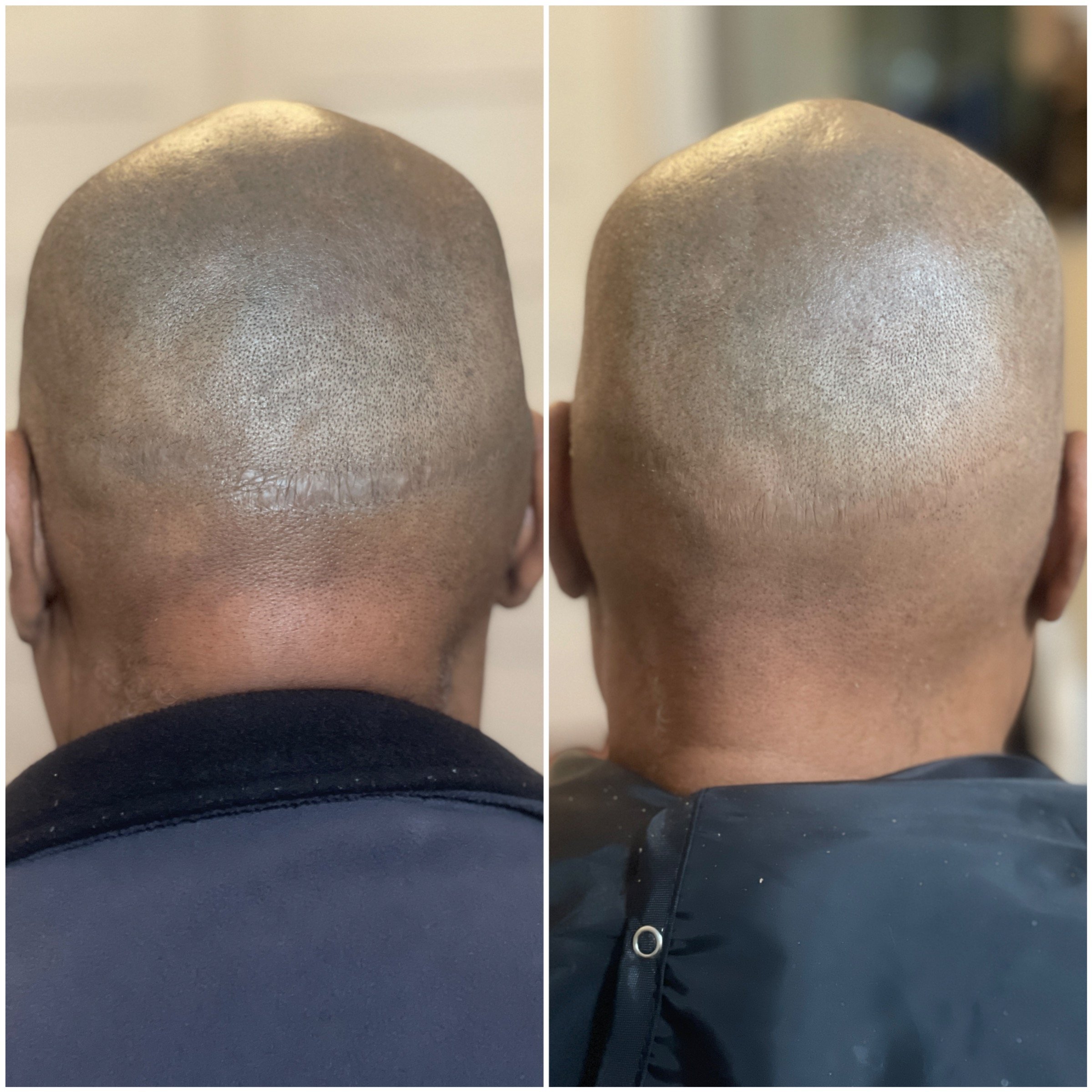 hair-transplant-scar-cover-lesson-sf-la-marialeemakeup.jpg