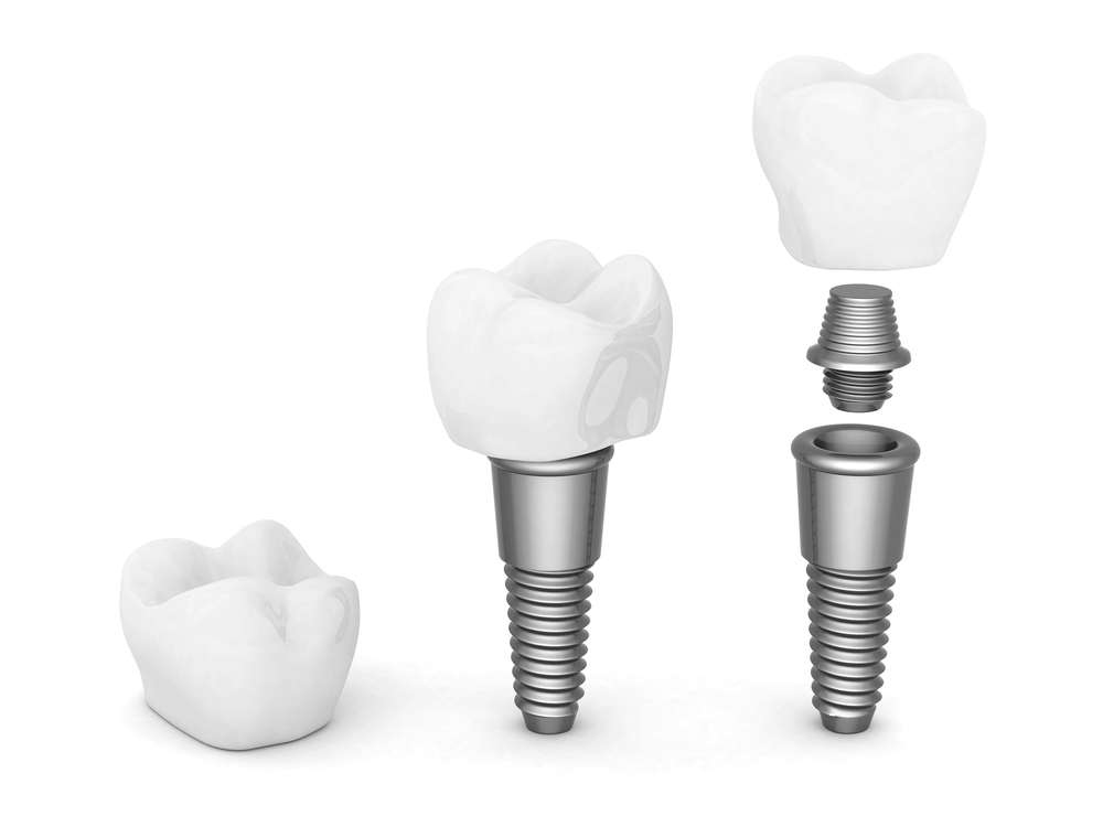 In this diagram you can see the different implant components. The implant crown, the implant screw, and the implant abutment.
