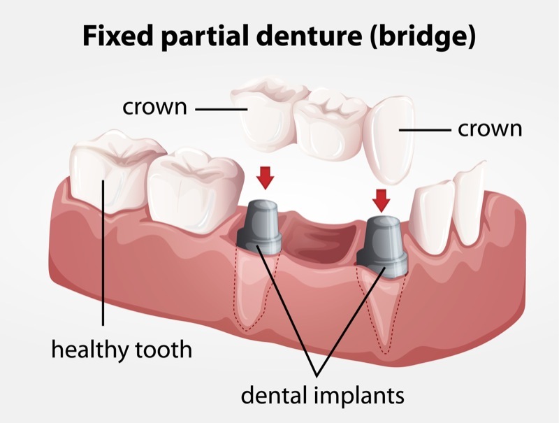 This is an example of how implantology can be used to replace a span of three or more missing teeth.