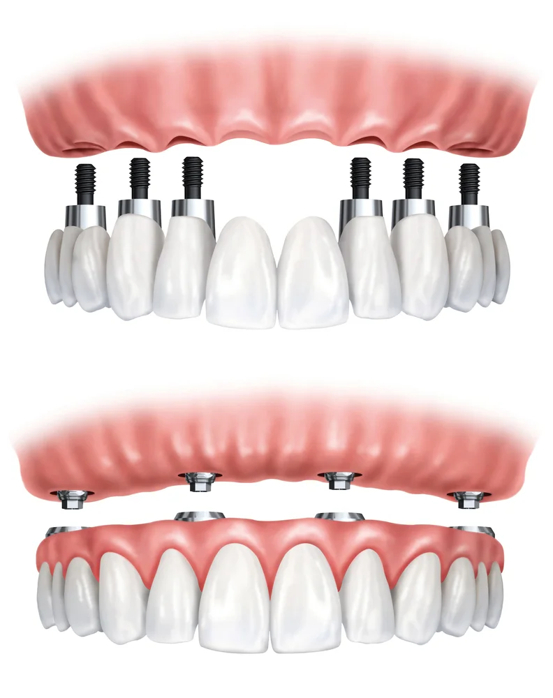 The top picture shows an implant based fixed bridge used to restore all the teeth in an arch. This may be used on either top or bottom, and is a non-removable appliance. The bottom picture shows a dentures that is being retained by implants. This is a unit that is removable but once "snapped" into place is very stable unlike plain dentures. This is called an "overdenture".