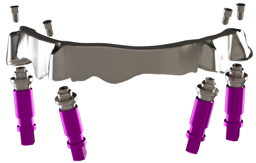 Direktverschraubter Steg auf Multi-Unit Abutments.