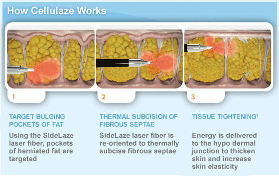 Anti-Cellulite_how-it-works.gif