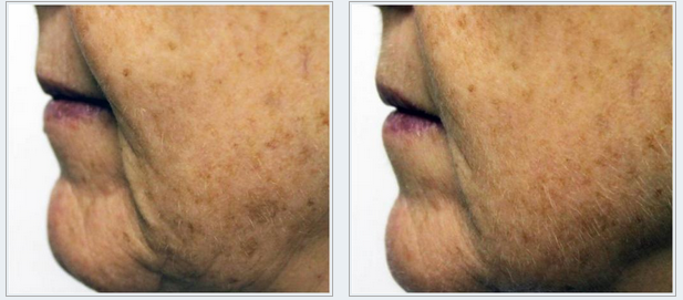 Six weeks after one treatment.