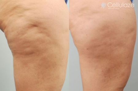 Before-After-Cellulaze-Dibernardo-6mo-3.jpg