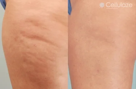 Before-After-Cellulaze-Dibernardo-6mo-1.jpg