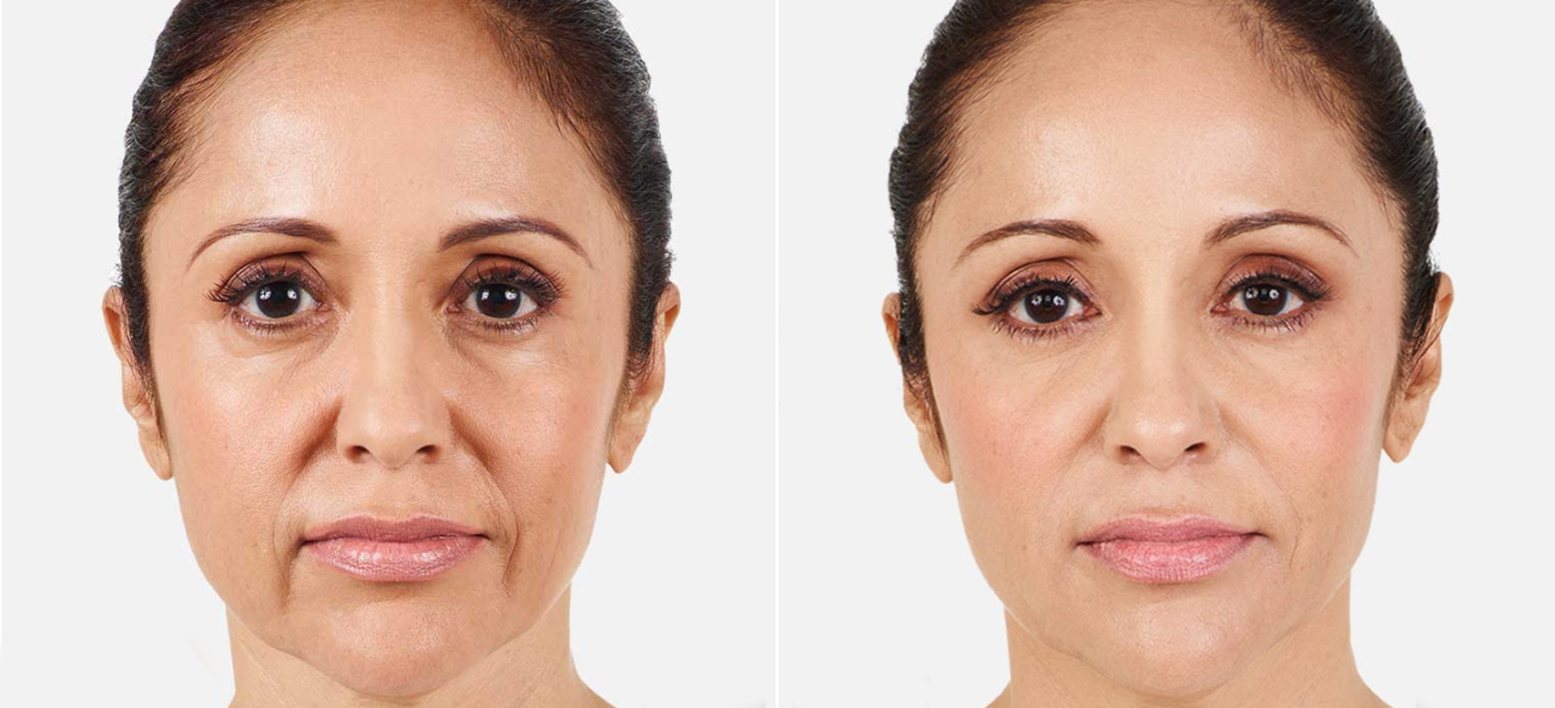 Actual patients. Result may vary. Unretouched photos taken before treatment and 2 weeks after treatment. A total of 3.2 mL of JUVÉDERM® XC was injected into the parentheses, marionette, and corner lines.