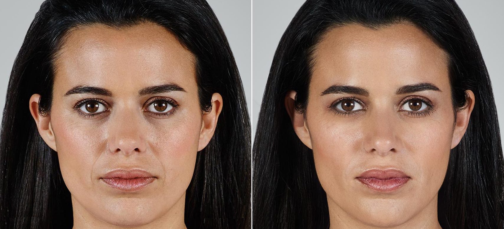 Actual patients. Result may vary. Unretouched photos taken before treatment and 2 weeks after treatment. A total of 2.3mL of JUVÉDERM VOLLURE™ XC was injected in the parentheses, corner and marionette lines.