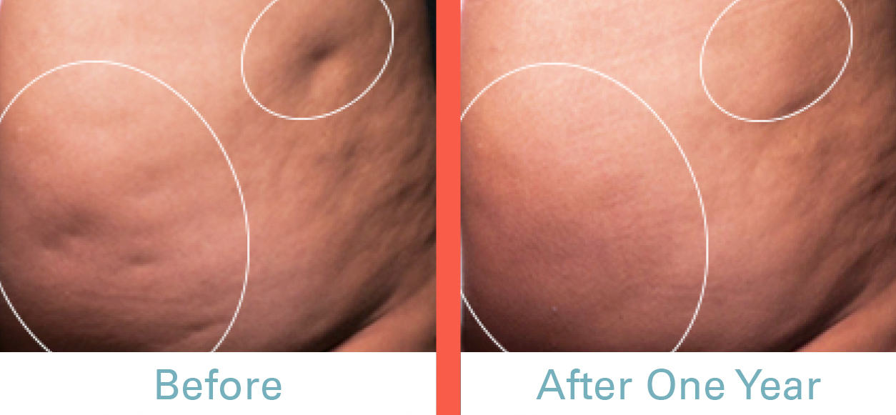 Cellfina Before & After Photo A.jpg