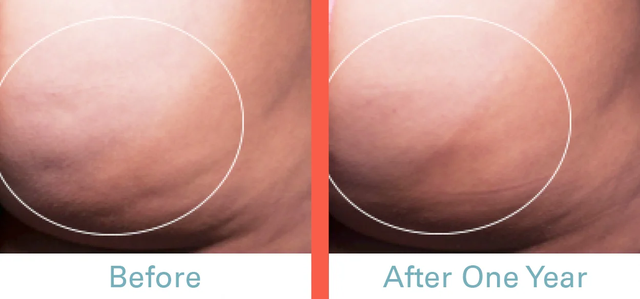 Cellfina Before & After Photo B.jpg