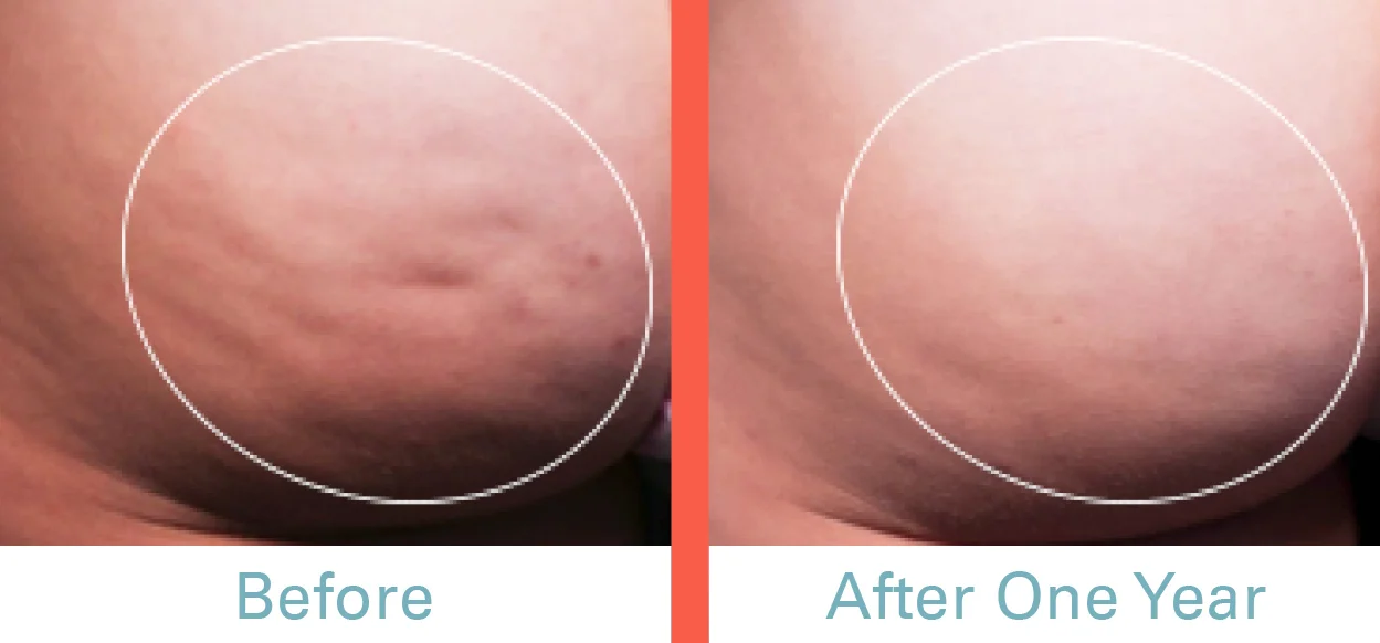 Cellfina Before & After Photo C.jpg
