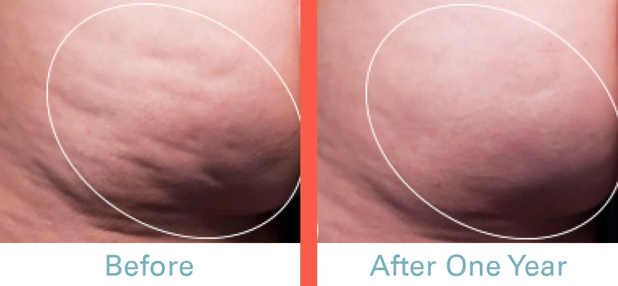 Cellfina Before & After Photo D.jpg