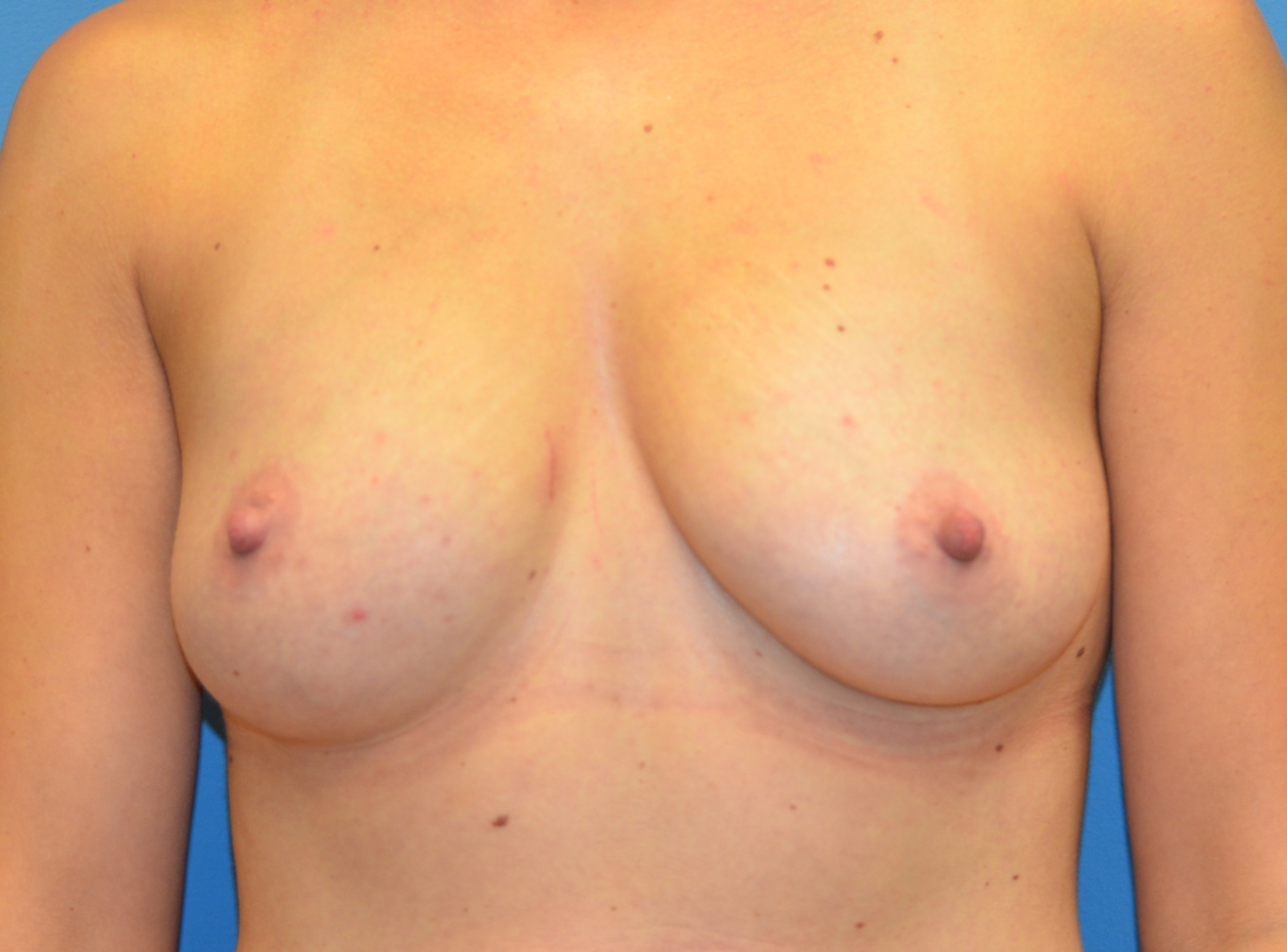 9594-breastaug-before.JPG