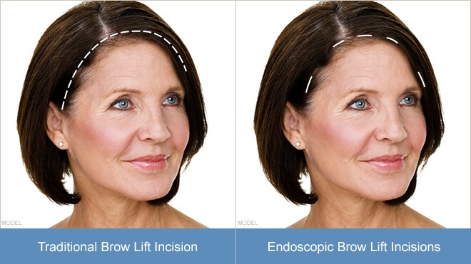 HCH-browlift-incisions.jpg
