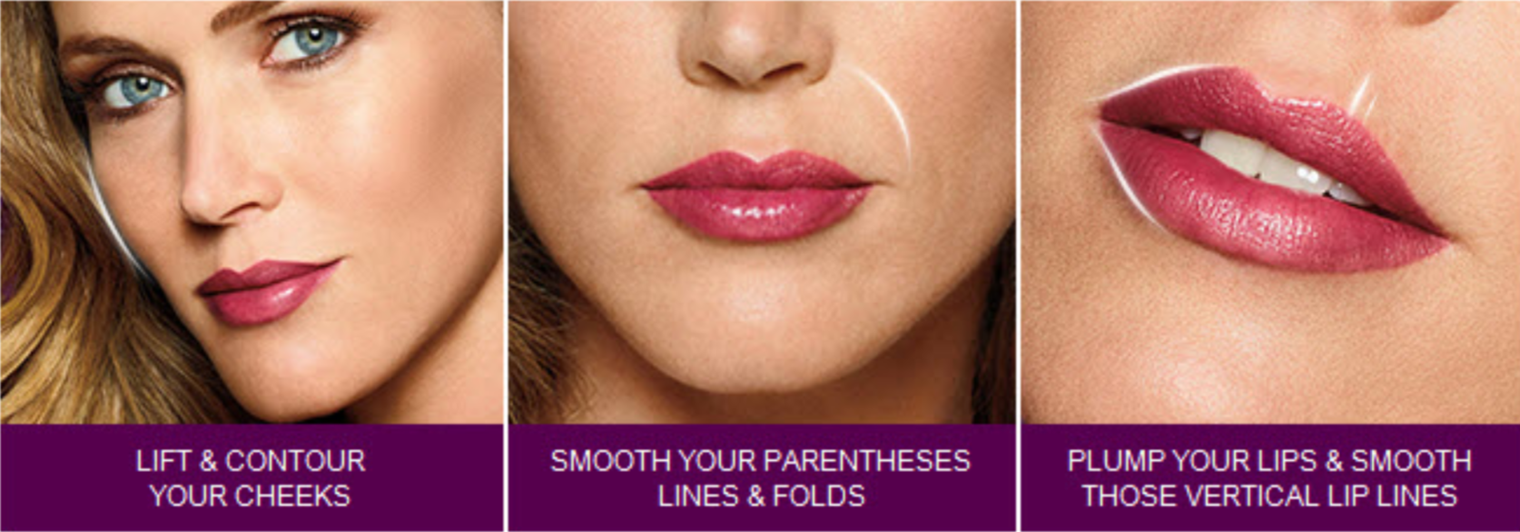 juvederm-areas.png