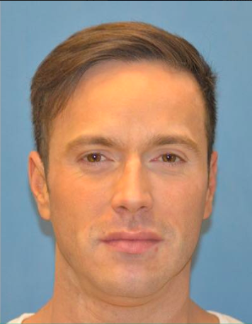 sculptra after.png