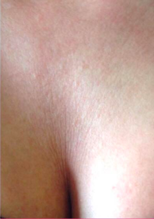 sculptra chest after.png