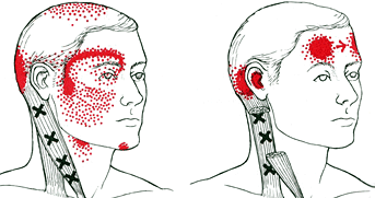 Additional common trigger points that can cause headaches.​