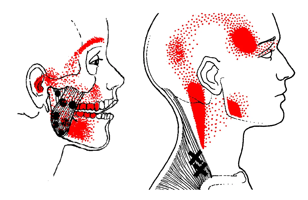 Common trigger points that refer pain to the head and face.​