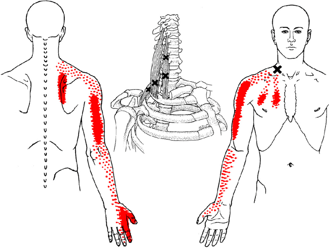 Trigger points can refer pain to other muscles in the body.​