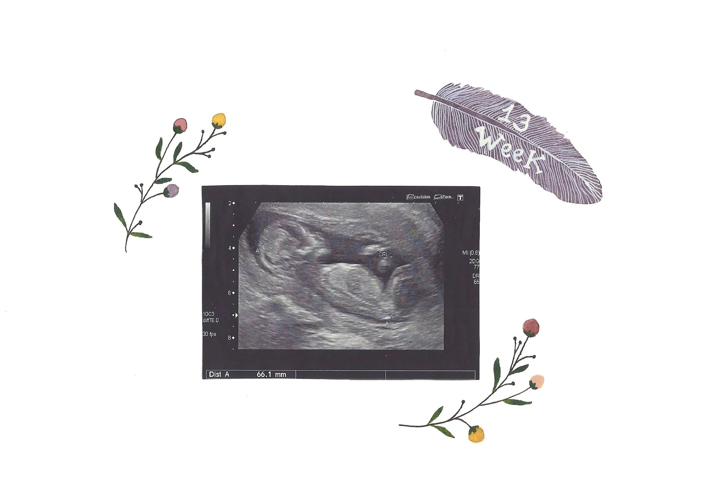 13 week ultrasound scan