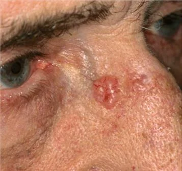 Basal Cell Carcinoma. Image credit medicinenet.com