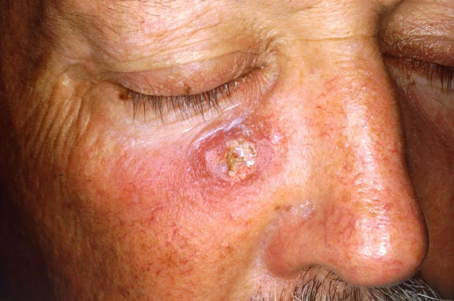 Squamous cell carcinoma. Image credit symsys-molemate.com