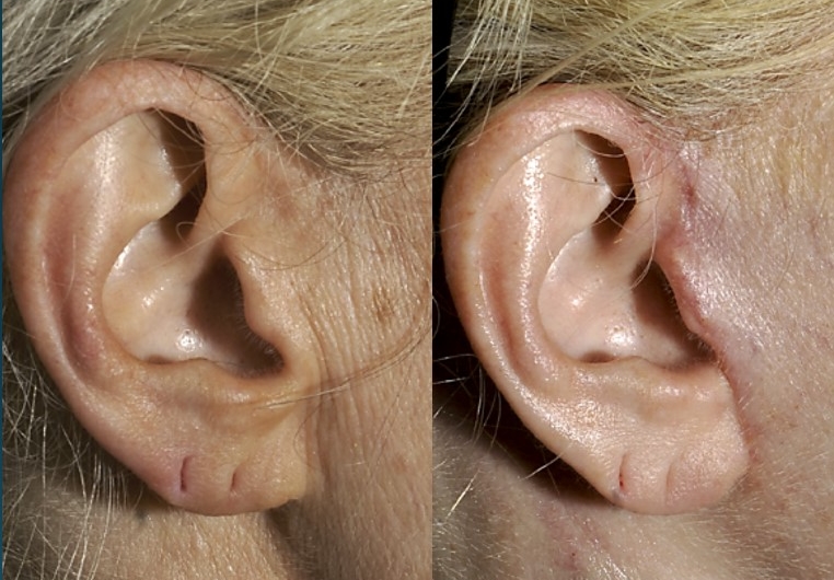 Actual patient of Dr. Devgan. Before and 2 months after facelift