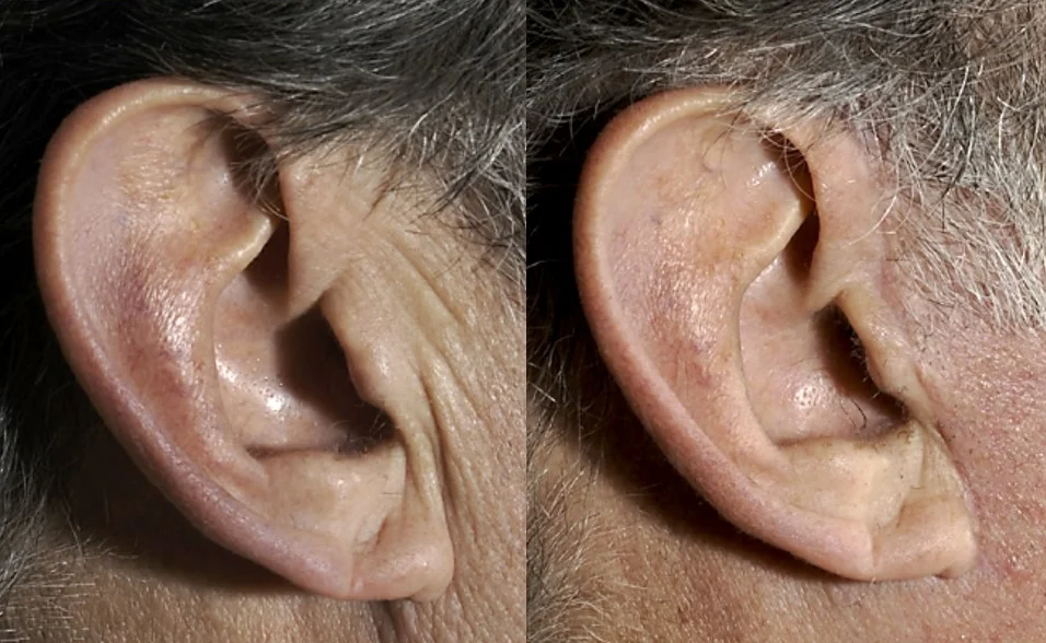 Actual patient of Dr. Devgan. Before and 4 months after necklift