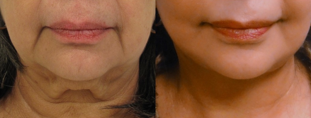 Actual patient of Dr. Devgan, ethnicity: Middle Eastern. Before & 2 months after facelift