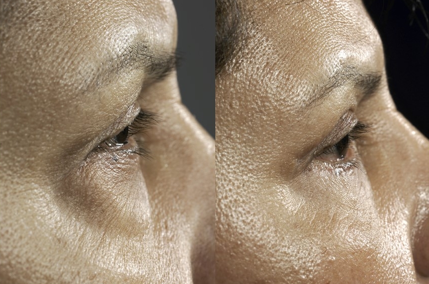 Actual patient of Dr. Devgan. Before & 3 months after upper and lower eyelift
