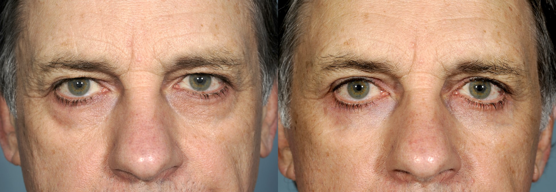 Before & 3 months after upper and lower blepharoplasty (eye lift)