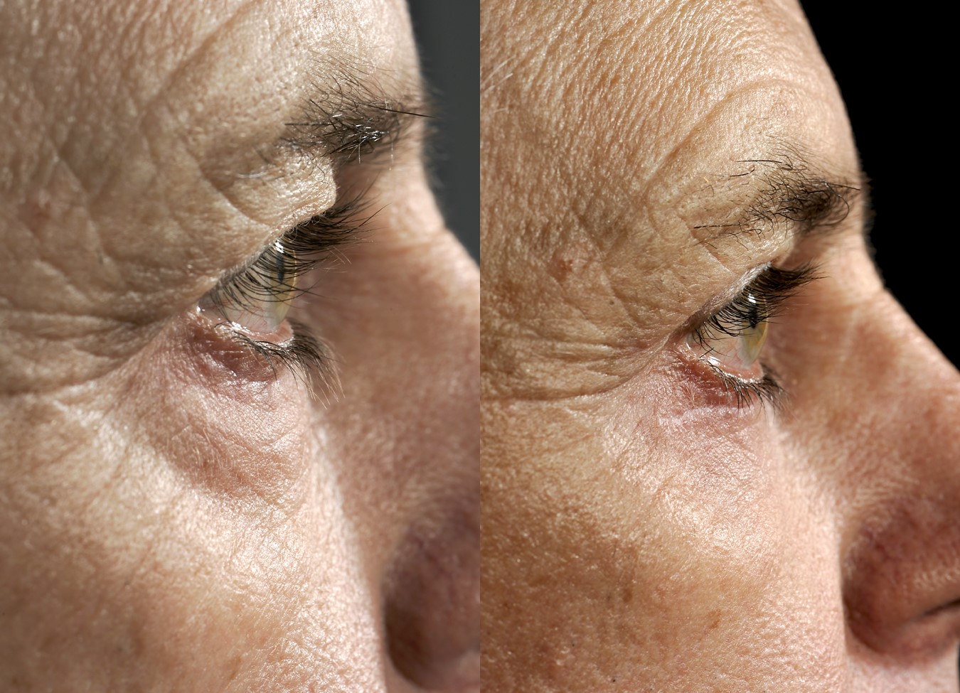 Before & 3 months after upper and lower blepharoplasty (eye lift)