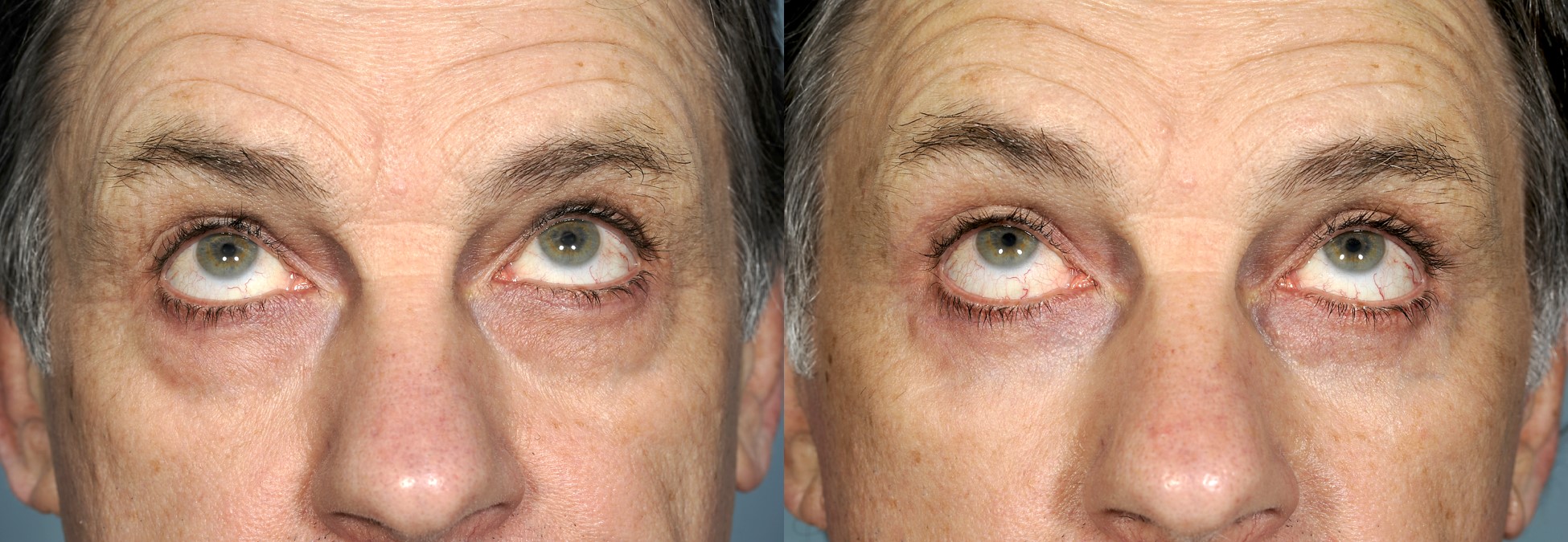 Before & 3 months after upper and lower blepharoplasty (eye lift)