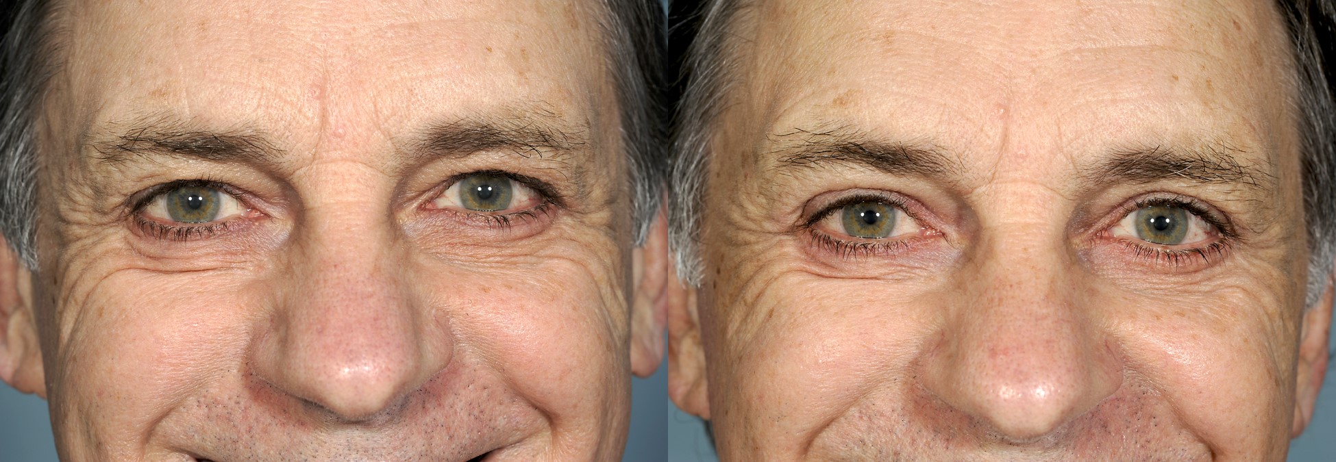 Before & 3 months after upper and lower blepharoplasty (eye lift)